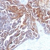 FFPE human ovarian carcinoma sections stained with 100 ul anti-TAG-72 / CA72.4 (clone CC49) at 1:300. HIER epitope retrieval prior to staining was performed in 10mM Citrate, pH 6.0.